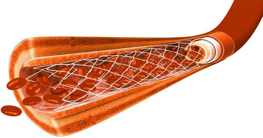 NPPA increases stent prices by around 2% NPPA increases stent prices by around 2%